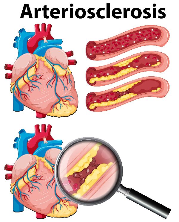 Wenn es eng wird, droht Herzinfarkt: Ansammlungen in den Arterien - sogenannte "Plaques" können den Blutdurchfluss behindern und zum Herztod führen.