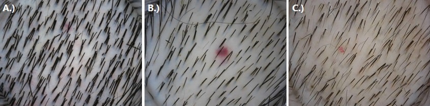 Dermoskopische Bilder der Kopfhaut in verschiedenen Stadien der Alopezie. A) Normale Kopfhaut mit 2-4 Haaren in den meisten follikulären Einheiten. B) Frühe androgenetische Alopezie mit einer Mischung aus mehreren und einzelnen Haaren in den follikulären Einheiten. C) Fortgeschrittene androgenetische Alopezie mit dünnen und einzelnen Haaren in den meisten Follikeleinheiten. (Bildquelle: Asfour et al., 2023)